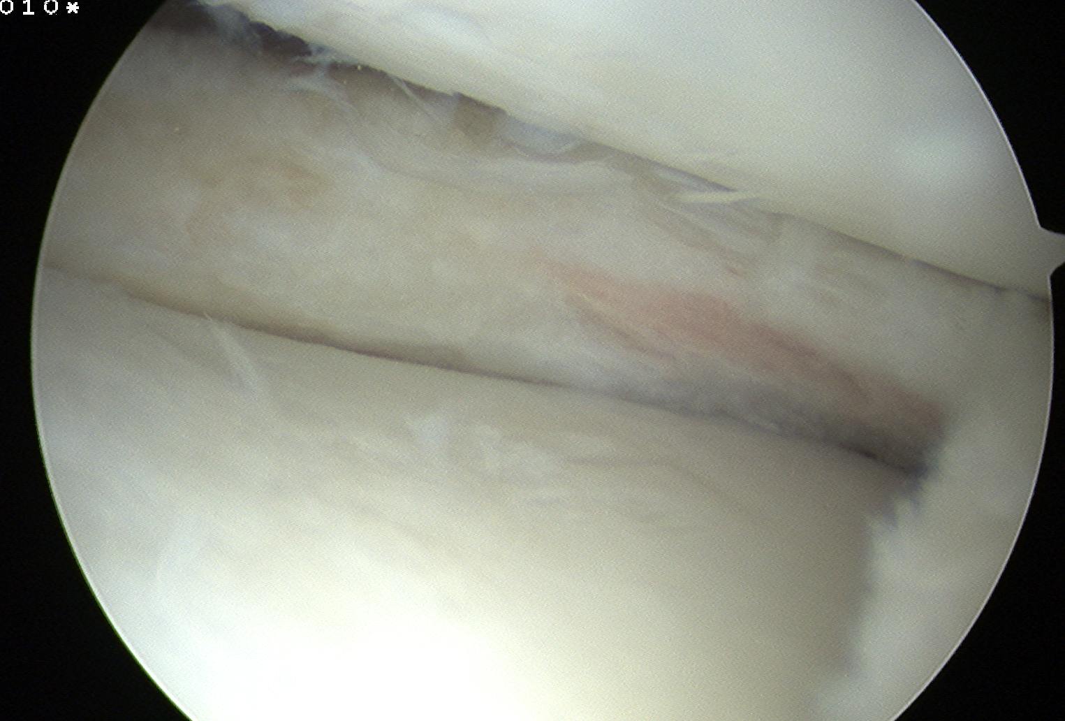 Discoid Meniscus Post Saucerisation